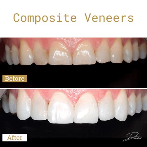 cost of composite veneers.